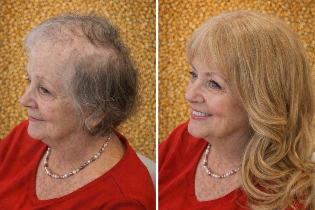 hair loss recovering in charing